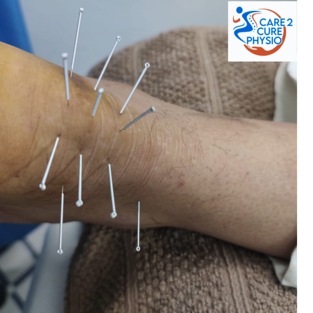 Why Dry Needling is an Effective Physiotherapy in Releiving Pain : Care2curephysio Bahadurgarh