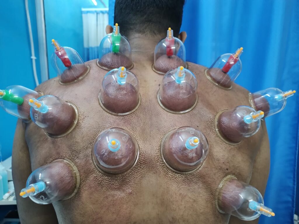 Cupping Therapy Treatment By Care2curephysio  : Dr. Pardeep Kumar (M.P.T)